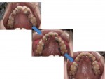 歯の移動のメカニズム