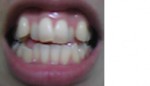 八重歯が気になり目立つ上の前歯６本だけ治し、部分矯正？