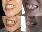 八重歯の隣の歯が引っ込んで舌にあたる、部分矯正の治療