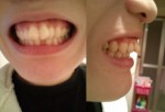 中学まで指しゃぶり、前歯が出っ歯に、前歯の部分矯正は