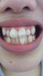 1年後に結婚式、差し歯もあり、私の歯で部分矯正は可能?