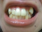 左右にある八重歯と歯並びにコンプレックスあり（大学生