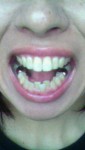 写真)上の前歯２本と下の中央を治したい。期間や概算をお教え