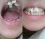 前歯2本が大きく前後に傾むき口を閉じても前歯が出て 24歳