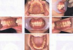 舌側矯正で歯をけずる形の部分矯正が可能？出っ歯で