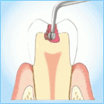 削らない歯の治療「カリソルブ」をご存知ですか？