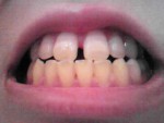 21歳の女性です。前歯の２本がすきっ歯で悩んでいます。