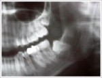 歯科のレントゲンは本当に安全？Ⅹ線写真と被爆について