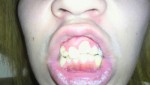 左前歯が出ている。この前歯一本の歯列を直すのはいくら？