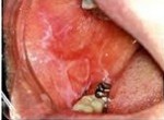 ＜医学博士が解説＞ご婦人に多い口の中の病気”口腔扁平苔癬”をご存知ですか？