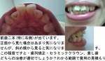 写真) 前歯二本(特に右側)が出てる。治療は矯正と差し歯どっち？