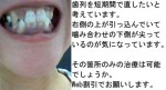 写真) 歯列を短期間で直したい、右側の箇所のみの治療は可能？
