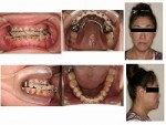 欠損歯の多い方の外科矯正