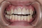前歯の重要性