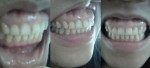 10年前に非抜歯で矯正治療を行いました。歯が歯茎ごと出