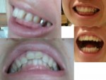 前歯2本が出っ歯、前歯だけの矯正希望、乳歯上から永久歯