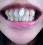 前歯が斜めになっていて出っ歯、前歯だけの治療法、費用、