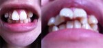 歯並びと出っ歯で昔から悩んでいる。歯の裏側から矯正した