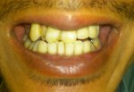 (写真)八重歯のせい？ 年をとるごとに上の歯がズレて、一番安く