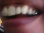 (写真)歯のホワイトニングは詰めている部分は白くならないと言わ