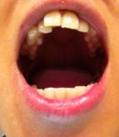 (写真)片方の前歯が重なった横の歯に押されてどんどん前に出て
