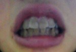 写真）歯の色、前歯12本をオールセラミックでなんとかしたい費用