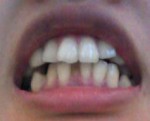 前歯が大きいと出っ歯が気になり、部分矯正などは可能？