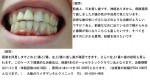 （写真）前歯上三本差し歯です、神経ありません、自然な歯の色に