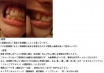 (写真)八重歯を治し歯並びを綺麗にしたい。短期間の施術の金額