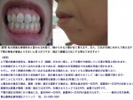 前歯は接端咬合と言われる状態で、横からみると顎が出て