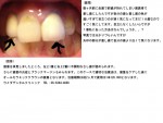 写真) 歯医者で差し歯にしたが、自分の歯との色が違いすぎて目