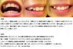(写真)3番目の歯が八重歯で、この歯だけを削りセラミックを被せ