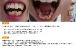 （写真）出っ歯と下前歯４本の歯並びが悪い、セラミッククラウン