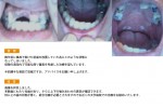（写真）事故で掛けた前歯を放置していた為にこのような状態に