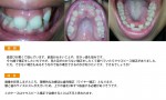 （写真）前歯が大きい、空きっ歯…マウスピース矯正は可能？