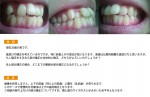 （写真）前歯とその周辺が気になり・・・部分矯正は可能？