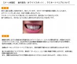 （写真）歯の変色（ホワイトスポット）　ラミネートベニアの強度は？