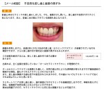 （写真）不自然な差し歯、歯茎が黒いのが気になる
