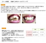 (写真)歯並びに悩み、前歯の二本をオールセラミックで？