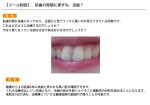 写真）前歯が虫歯で黒く…削るの？