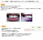 （写真）前歯の二本が出っ歯　セラミックでの治療を希望