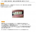 （写真）前歯の変色、歯茎と歯の隙間の黒い歯石のようなもの
