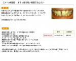 （写真）すきっ歯を短い期間で治したい