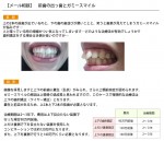 (写真)前歯の出っ歯とガミースマイル