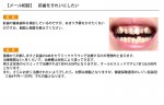 （写真）審美歯科で前歯をきれいにしたい