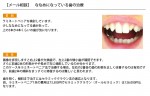 (写真)ななめになっている歯の治療