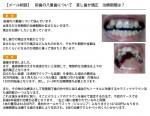 （写真）　前歯の八重歯について　差し歯か矯正　治療期間は？