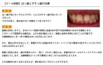 （写真）出っ歯とすきっ歯の治療