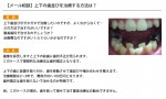 (写真)歯列矯正か？上下の歯並びを治療する方法は？