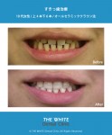 前歯のすきっ歯の治し方